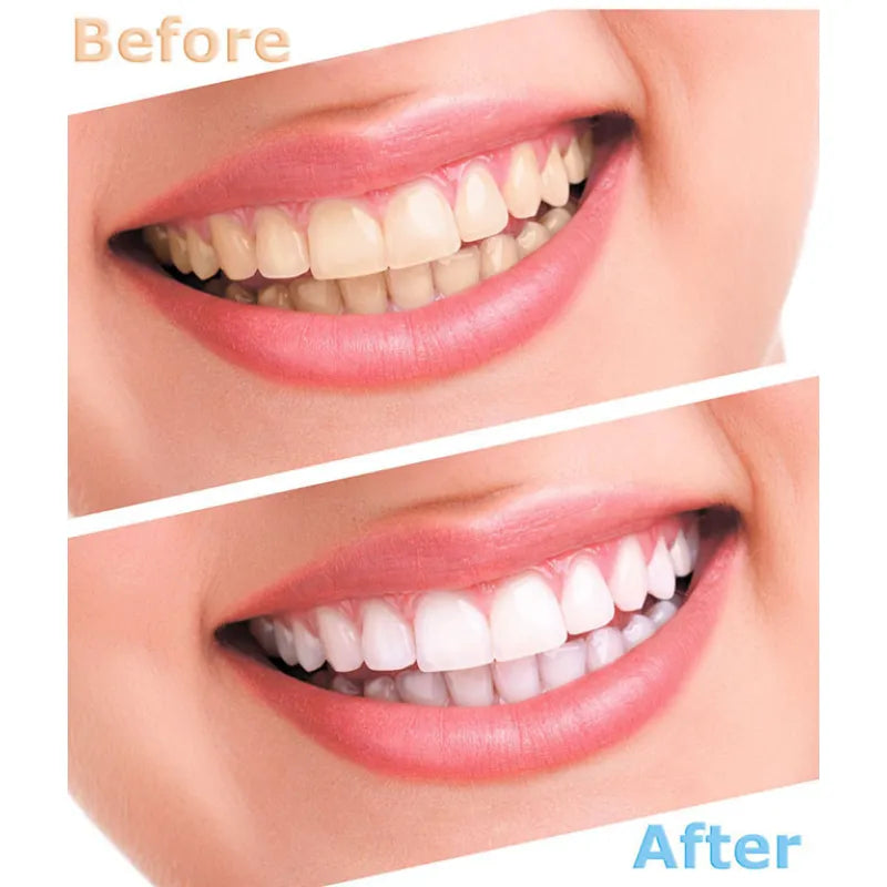 LumaSmile Teeth Whitening Kit